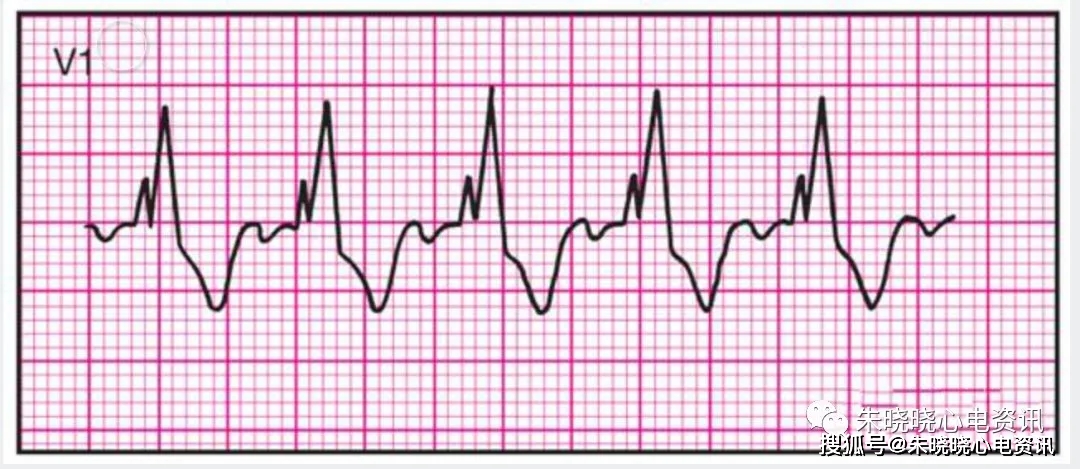 常见的14种异常心电图的波形特点,建议收藏.