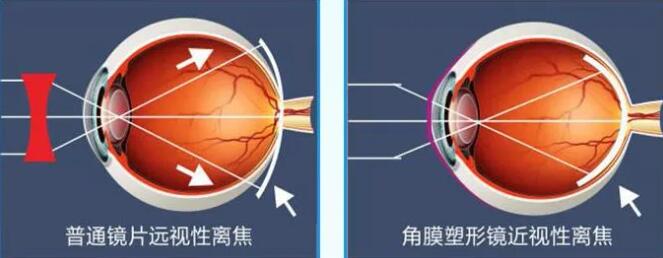 荆门角膜塑形镜验配—青少年近视矫正及控制的"秘密武器"