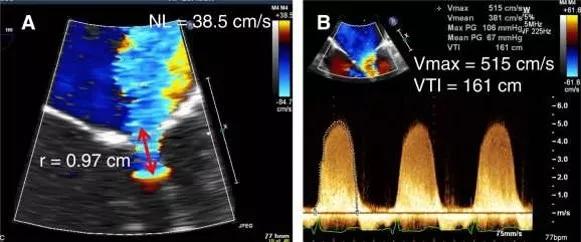 原创超声心动图十大基本功8.1:超声心动图评估瓣膜返流的常用方法