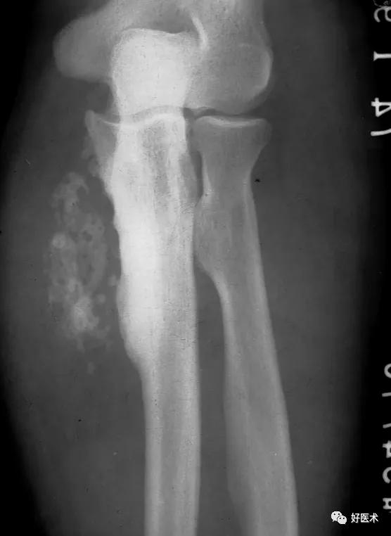 【影像表现】右足可见明显骨折后骨质疏松.