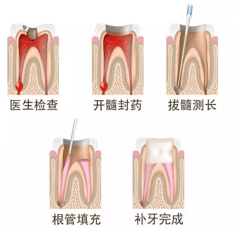 牙髓炎可以自愈吗