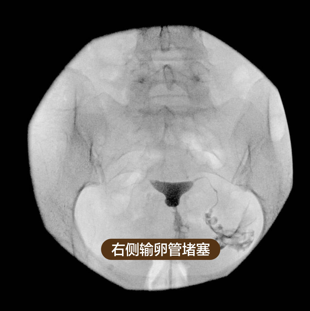 国健妇产医院首次开展无痛输卵管造影技术