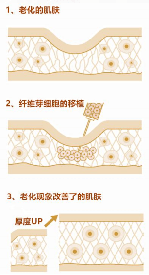 30岁 抗衰老神器,自体纤维芽干细胞是什么呢?_皮肤