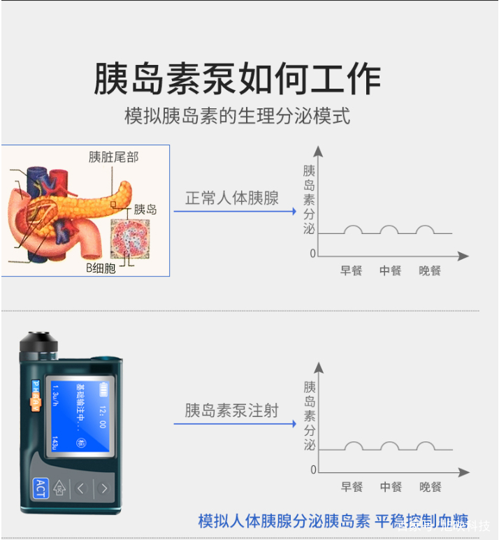 哪些糖尿病患者适合胰岛素泵治疗?