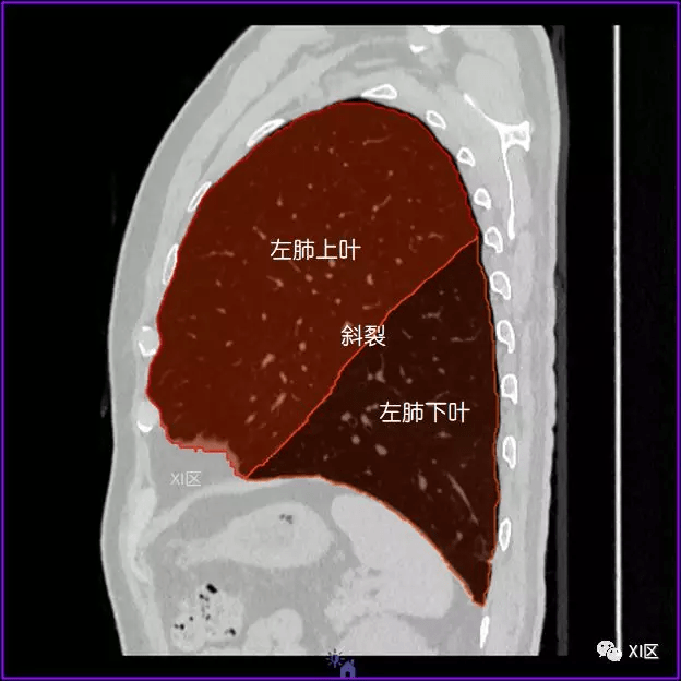 肺的分叶 左肺借斜裂成上,下两叶;右肺借斜裂和水平裂成上,中和下叶