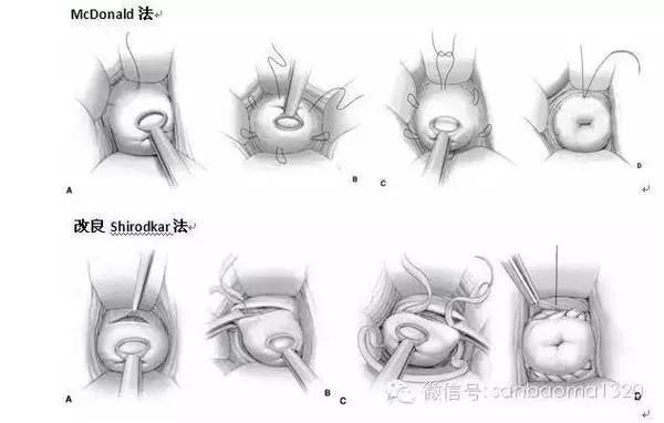 (三)子宫托