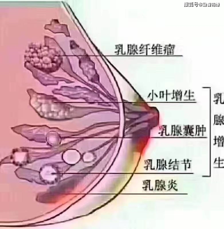 原标题:中医王财喜健康分享之胸部保养的重要性 80%的人有乳腺增生