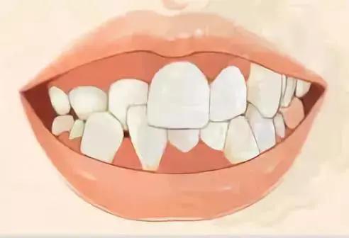 牙齿不齐的危害有多大,你知道吗?
