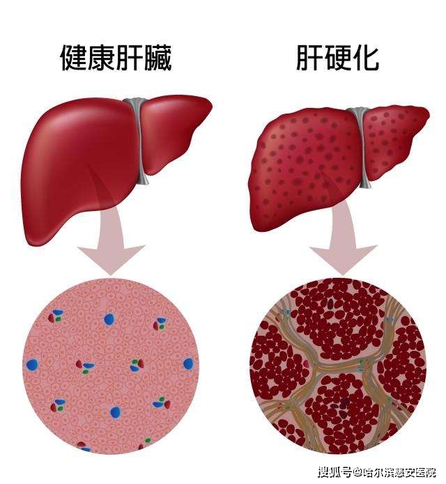 【肝硬化】身体发出哪些"信号"你得注意自己的肝了?