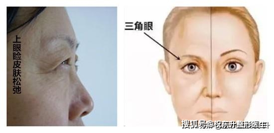 上睑皮肤松弛(三角眼),应该割双眼皮,还是做提眉手术?