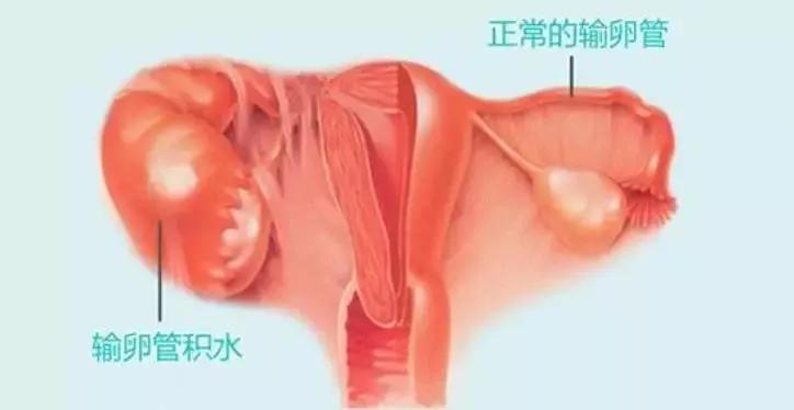 宫外孕有积液怎么办