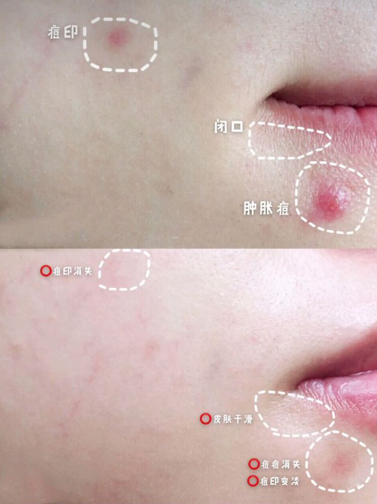 怎么才能不长闭口痤疮 ad8e0cb4781c44a99b38166c2a6d567f.jpeg
