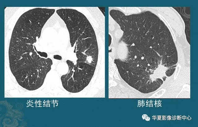 肺结节是怎么长出来的?医生教你看ct片,有2种可能是肺癌