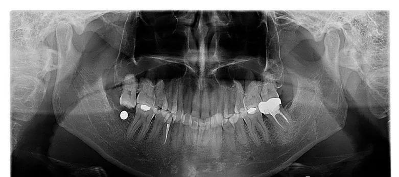 图8-20a缺牙间隙高度不够 47缺失,但对颌牙伸长后,缺牙间隙只有2~3mm