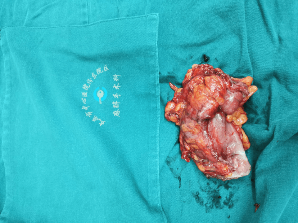 腹腔镜|太原中心医院胃肠外科汾东病区完成全腹腔镜下结肠癌肝转移同期术