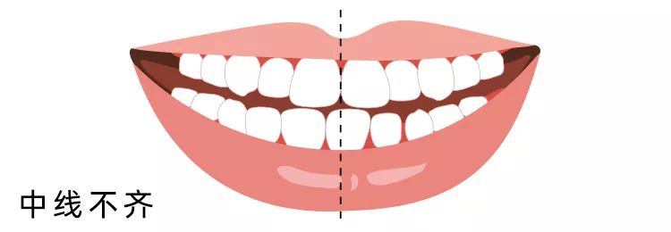 没有完美"牙齿中线,能通过正畸改善吗?