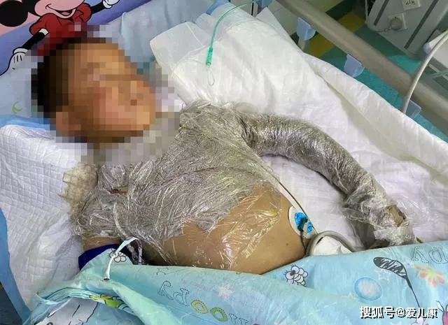 伤口|整个手变黑险丧命!带娃外出,千万当心这东西…男童摸了“花蘑菇”