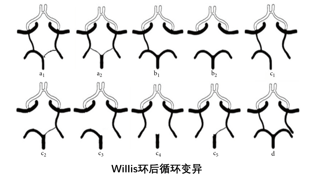 脑内的willis环,你知道吗?