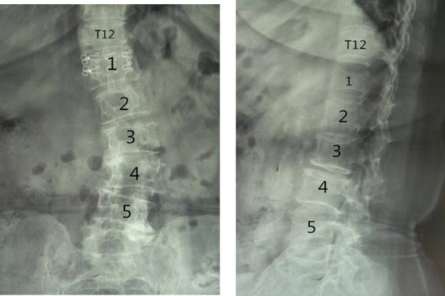 腰椎正侧位放射线示:胸12椎体和腰1椎体凹陷