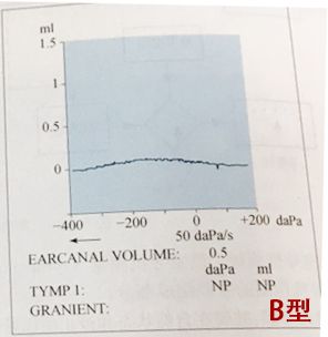 鼓室声导抗对中耳病变的诊断