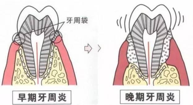 什么是牙周病及症状表现 984ee4aed4c54586bd28693b8aa19db6.jpeg