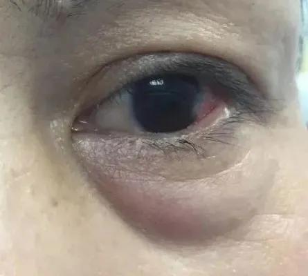 女明星|女明星“眼下增肥”是什么操作？