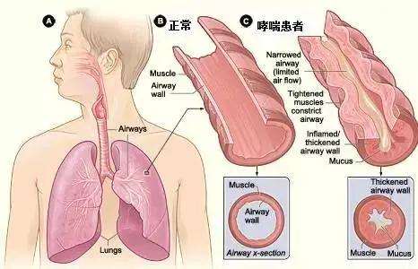 突发哮喘没有药怎么办