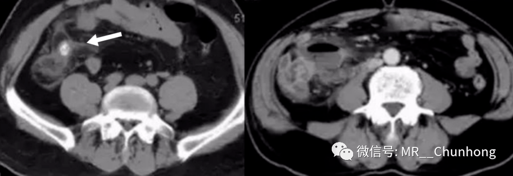 ct表现(前图可见阑尾壁不连续,后图可见粪石漏出及游离气体)(前图可见
