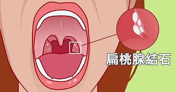 同时,小美还要提醒所有人,如果发现有扁桃体结石,要注意不要用手或