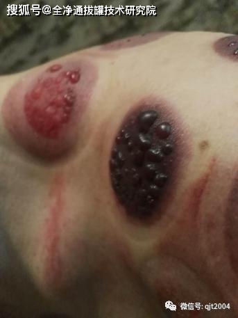 拔罐为什么会渗出来血 963ffd75bcb446e686ab2dc63869a18f.jpeg