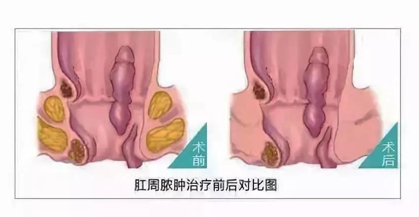 肛周脓肿不能自愈,一旦感染必须手术治疗