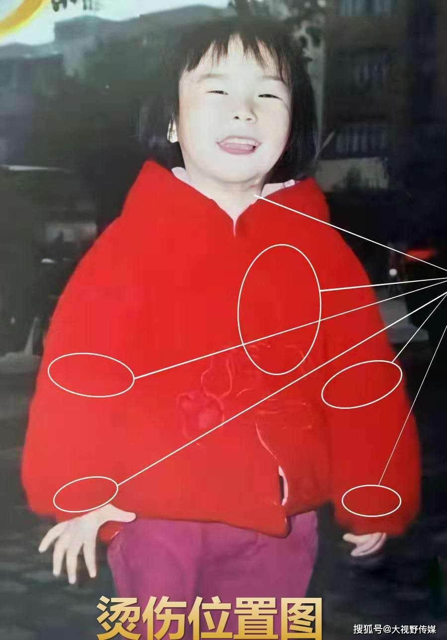 钟仁|创建平台帮助6个家庭团圆，自己的孩子却未找到父亲苦寻烫伤女儿14年