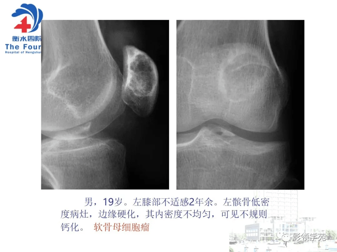 小结:1,髌骨肿瘤虽然少见,仔细观察影像学特征,再结合临床,大部分病例