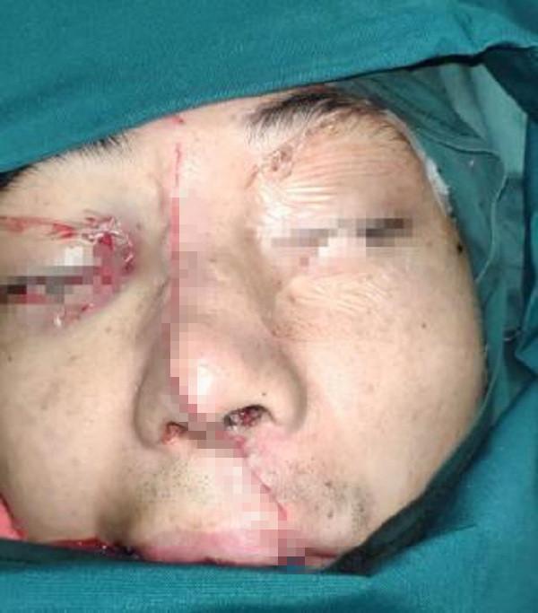徐州小伙的脸被电锯锯成两半多名医生花3小时为其拼脸