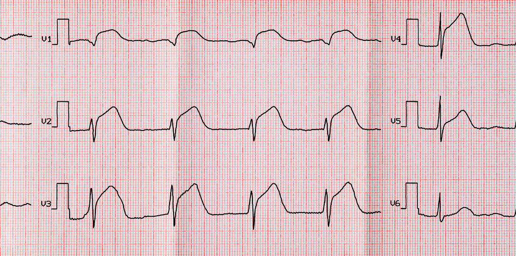 原创这样的心电图提示心脏最大血管堵塞!九死一生!