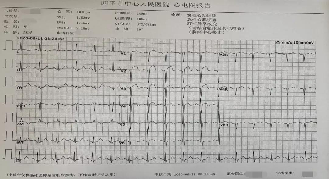 急性心肌梗死与心电图密不可分