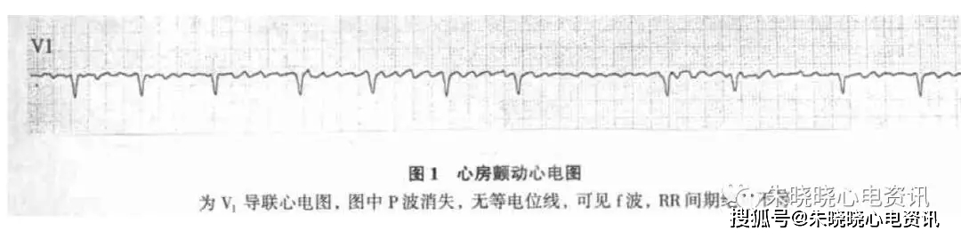 心房颤动心电图