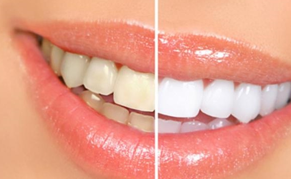 如何刷牙才能让牙不黄 67f6ef00a5344490addcd35988c8d3d3.jpeg