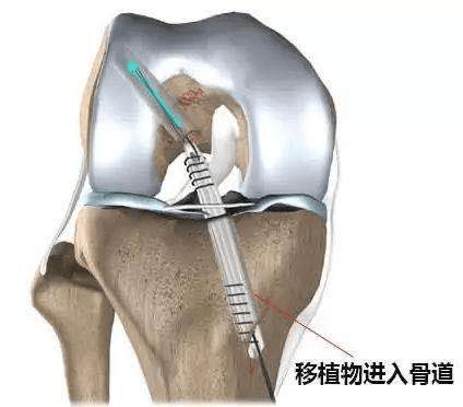 骨科知识||前交叉韧带损伤