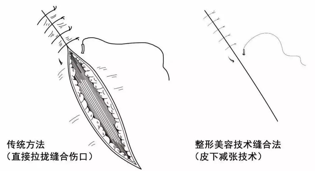 对于比较细的线状瘢痕,可以采取 美容缝合的方式隐藏掉疤痕.