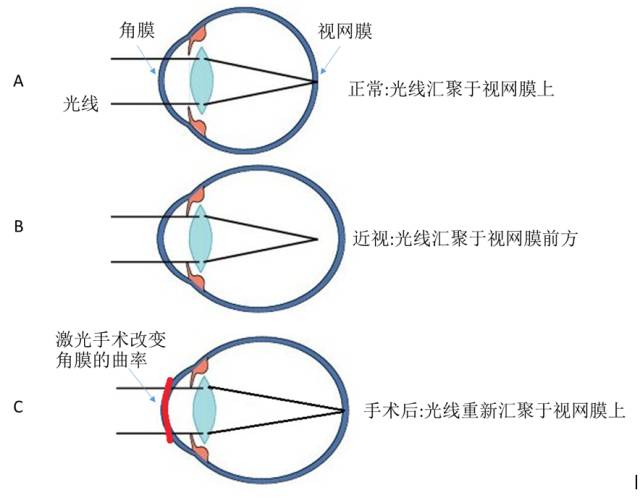 眼睛激光原理是什么_激光是什么样子图片(3)