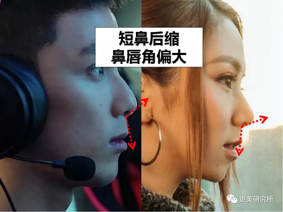 鼻尖|杨幂终于去修复鼻子了…