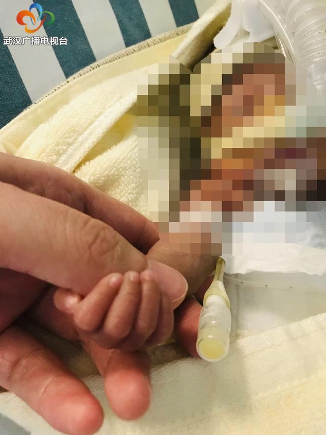 女婴|不容易！6个月超早产女婴活下来了 出生时仅500克