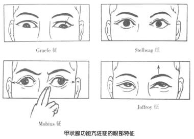 3,角膜病变:患者由于眼睑退缩,睑裂增大,眼睑无法正常闭合,可导致角膜