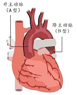 累及升主动脉的夹层,叫a型主动脉夹层,夹层朝着心脏方向撕裂;发生在