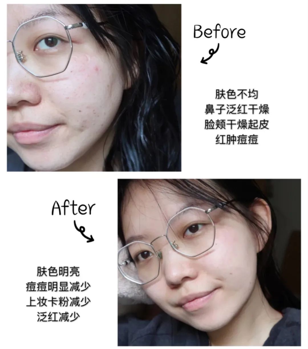 皮肤|秋冬换季护肤大作战