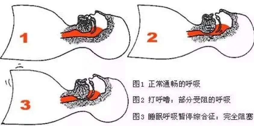 病房有人打呼噜怎么办