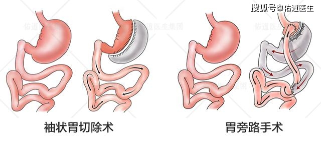 产后太胖了,做袖状切胃术能减肥成功吗?