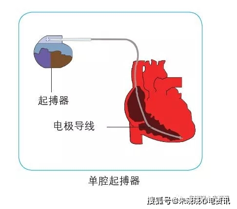 哪些患者需要植入单腔起搏器?