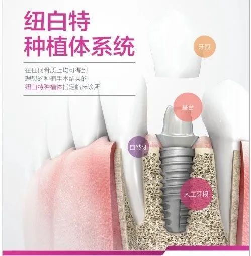 种植体排名_种植体图片